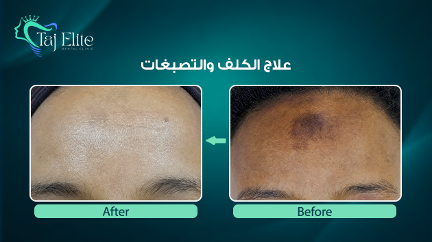 before-^-after7